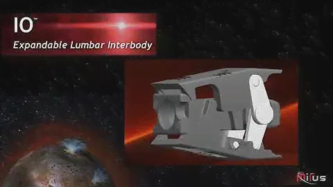 MiRus: IO™ Expandable Lumbar Interbody Fusion System